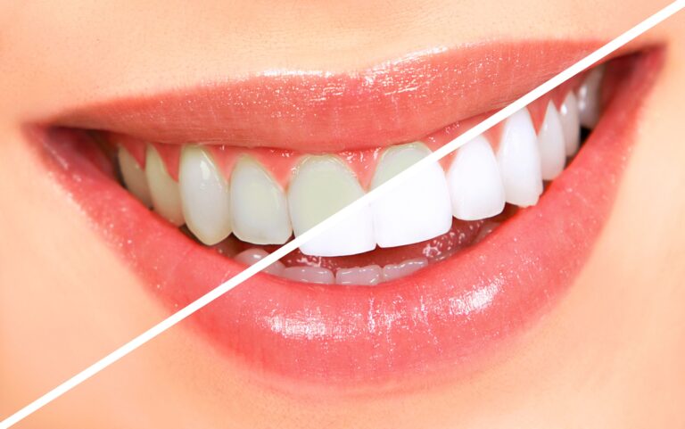 Experience Radiant Smiles with Ave Dental Clinic’s Teeth Whitening Services
