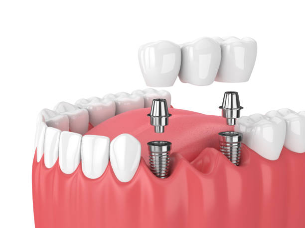 Dental Implants: A Permanent Solution for Missing Teeth at Ave Dental Clinic