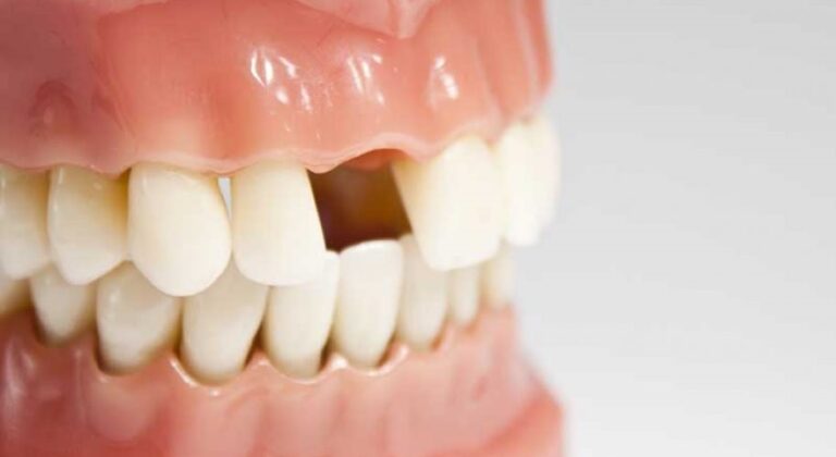 Restore Your Smile with Ave Dental Clinic’s Teeth Replacement Services