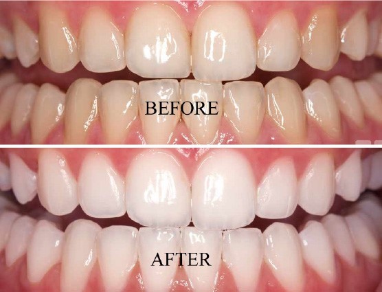 The Benefits of Professional Teeth Whitening at Ave Dental Clinic